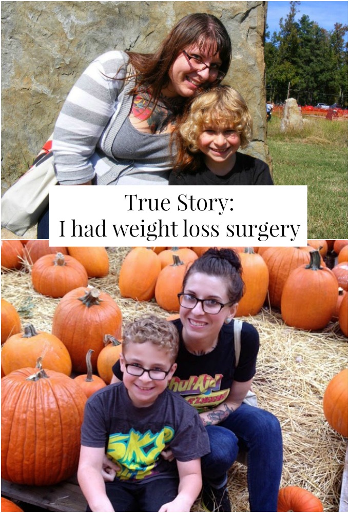 Weight loss surgery what to expect and experience with weight loss surgery